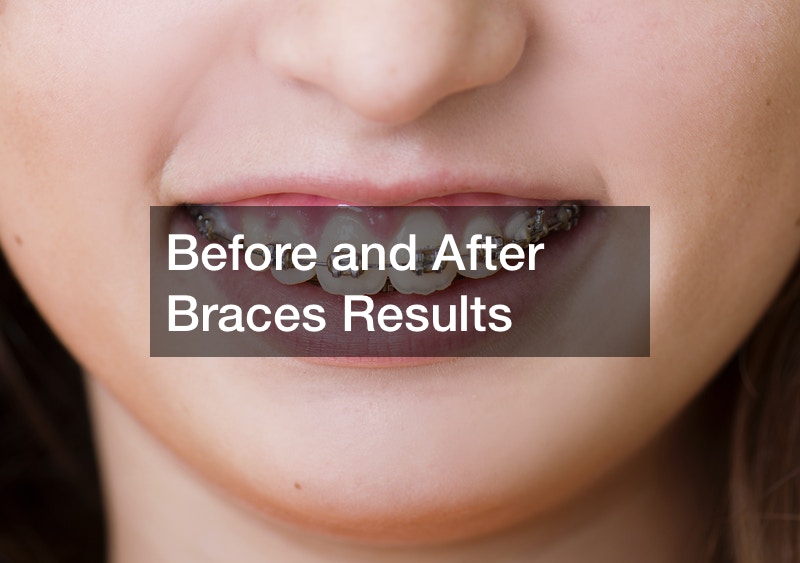 Before and After Braces Results